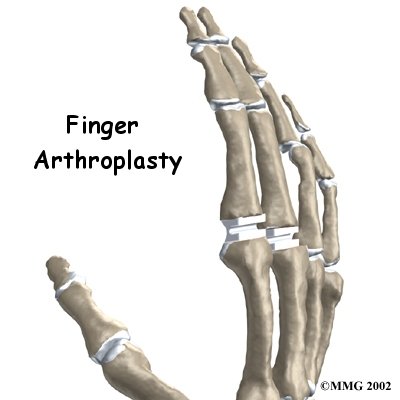 Artificial Joint Replacement of the Finger - Physio Max's Guide